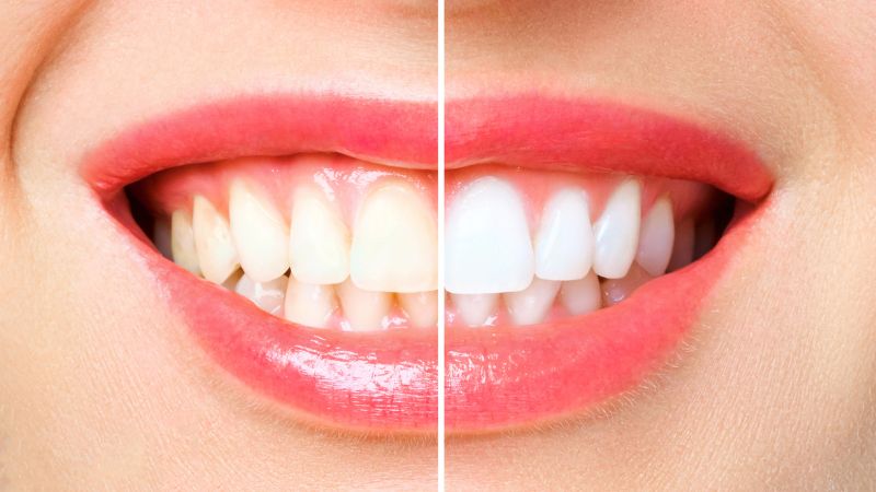 whiten teeth before and after